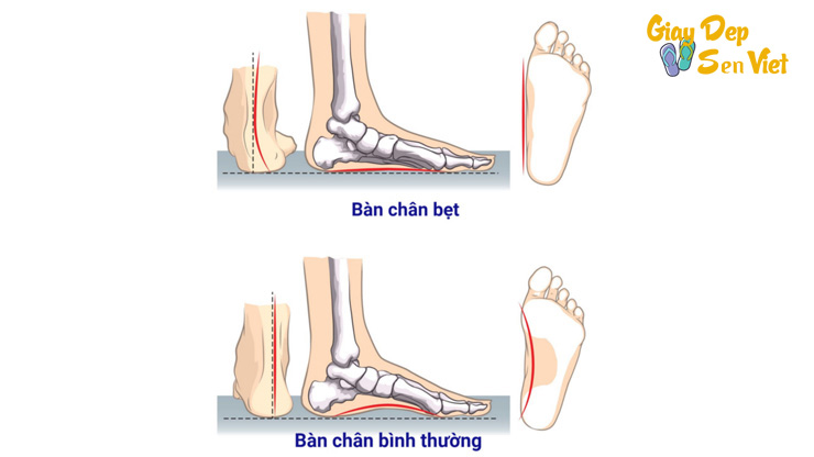 Bàn chân bẹt là gì